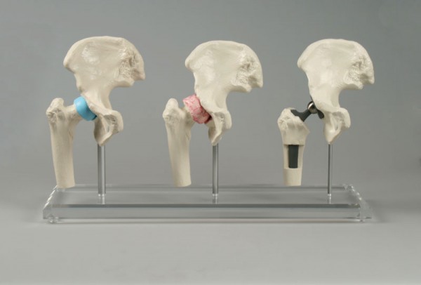 Hüfte Implantat Modell Anatomie